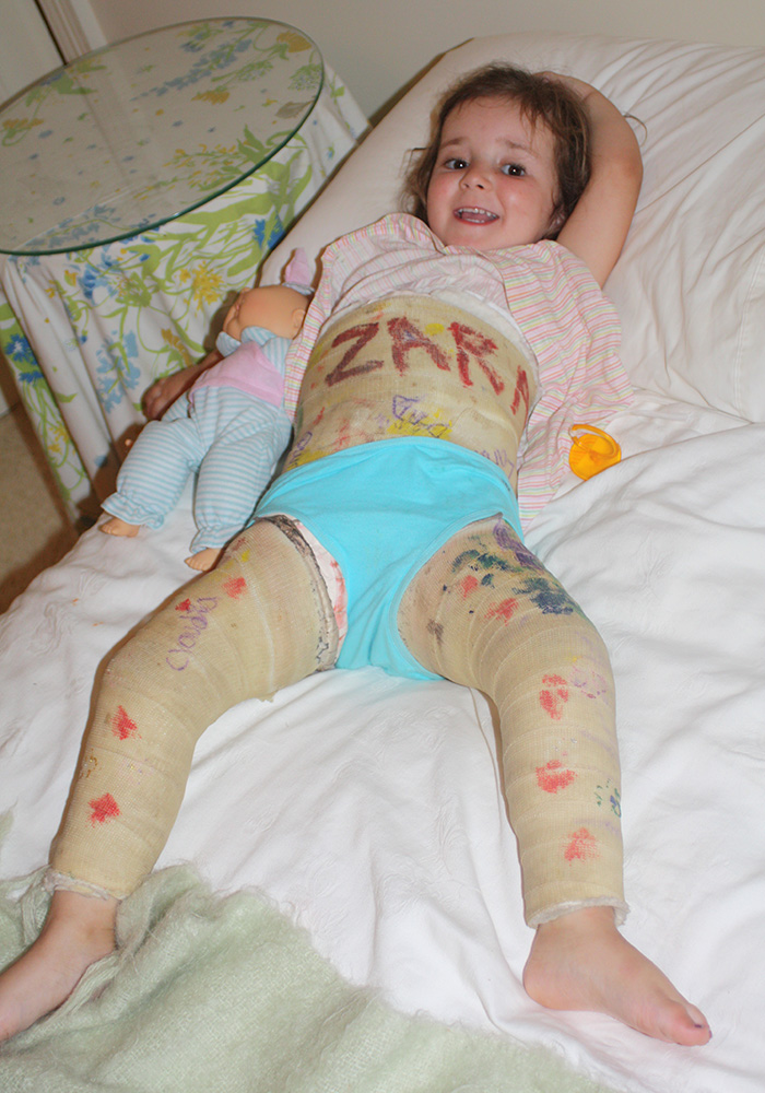 Zara in a body and leg cast