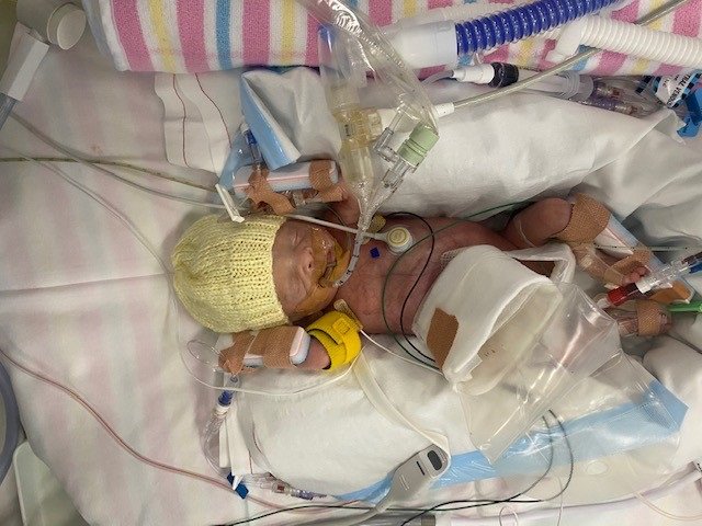 Premature newborn Archie in hospital