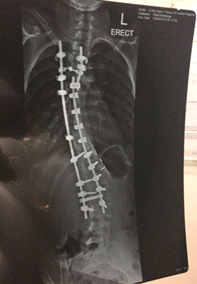 An x-ray of Hannah's spine