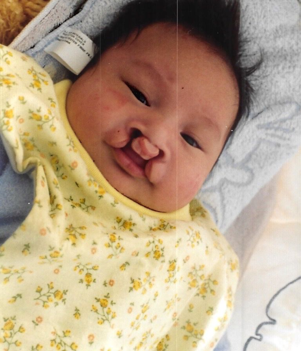 Newborn Patrick with cleft palate