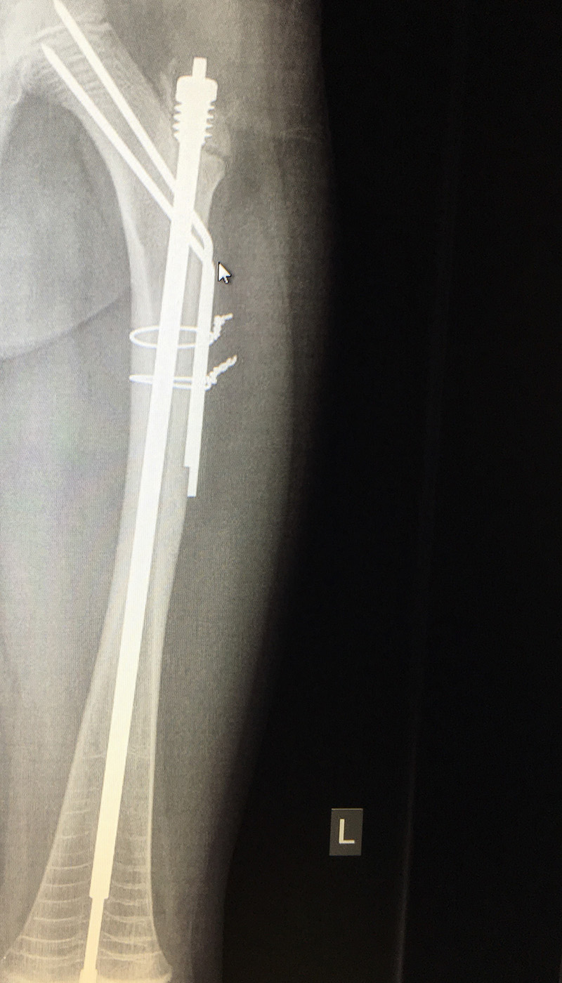 An X-ray of Zara's broken bone